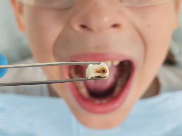 Best Emergency Wisdom Tooth Extraction in Independence, LA